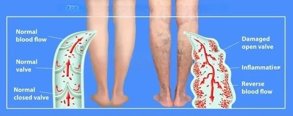 Diagram of Chronic Venous Insufficiency