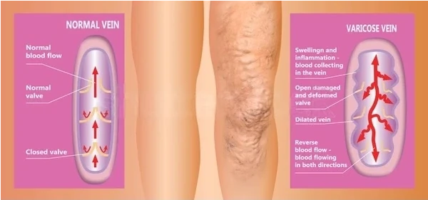 Diagram of Chronic Venous Insufficiency